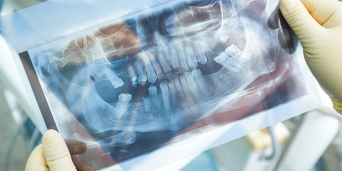 Bone Grafting Bone Loss X-ray