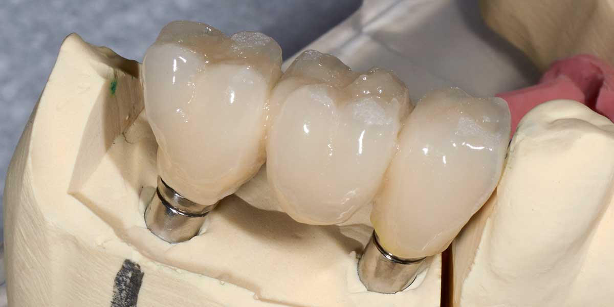 Dental Implant Supported Bridge