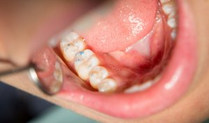 Marking bite contact points for dental Occlusal Adjustment