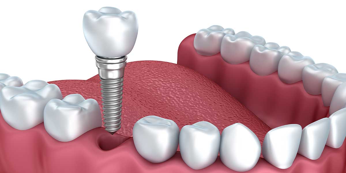 Dental Implants in Easton