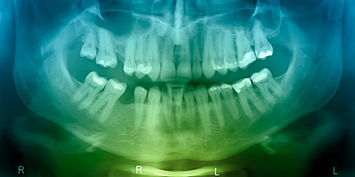 X-ray Image of Missing Tooth