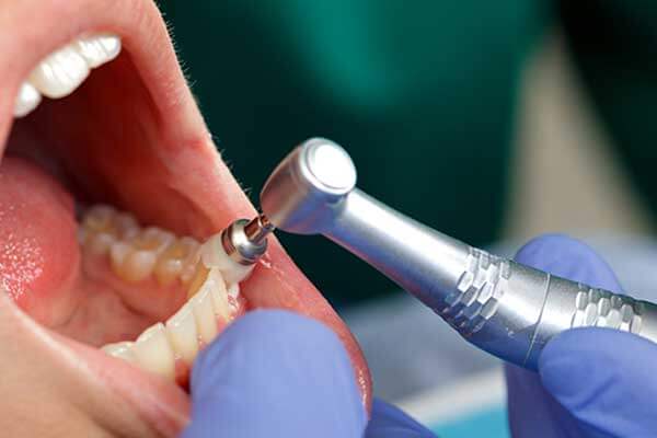 Appliance removing dental plaque