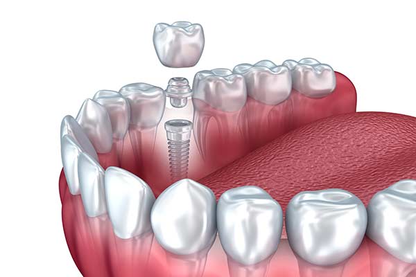 Implant Restorations