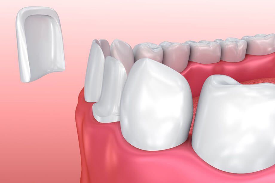 How Can I Make My Dental Veneers Last Longer?