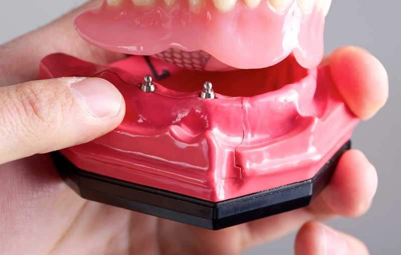 Mini Dental Implants in Easton, PA