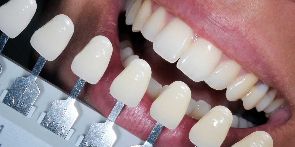 Composite Fillings